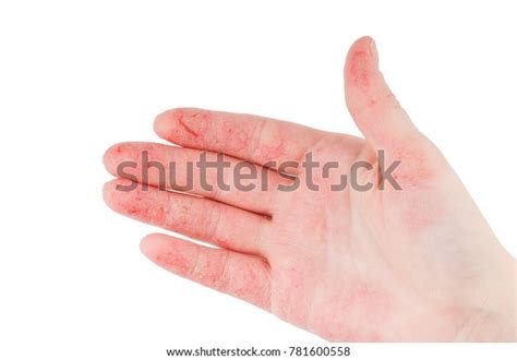 Womans Hand Wounds Eczema Dermatitis Stock Photo 781600558 Shutterstock