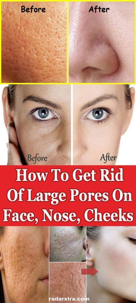 How To Get Rid Of Large Pores On Face Nose Cheeks Dailyfacecare