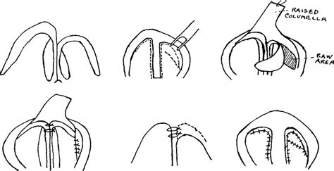 A Modified V Y Chondromucosal Composite Flap For Correction