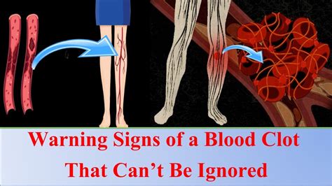 Warning Signs Of A Blood Clot That Can T Be Ignored Youtube My Xxx
