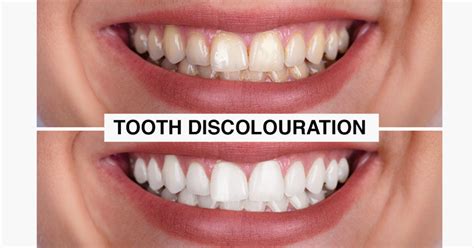 tooth discolouration prevention and treatment sky dental care