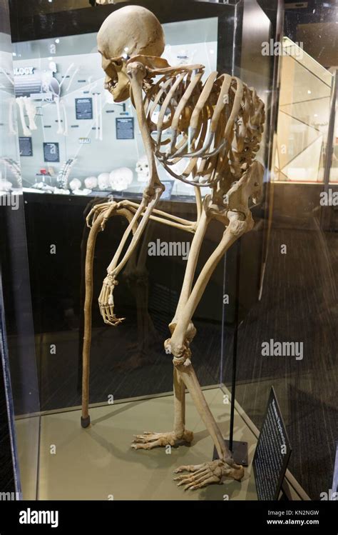 The Skeleton Of A Man With A Hunchback At The Skeletons Museum Of