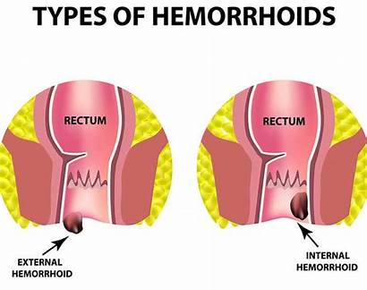 Hemorrhoids External Internal Rectum Types Sclerotherapy Hemorrhoidal