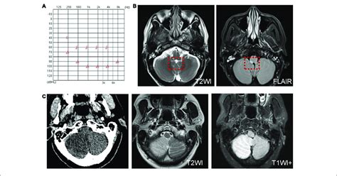 Examination Results Of Patients With Infarction Of The Cochlear And