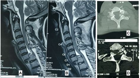 Flexion Compression Type Of Traumatic C7t1 Cervical Spondyloptosis