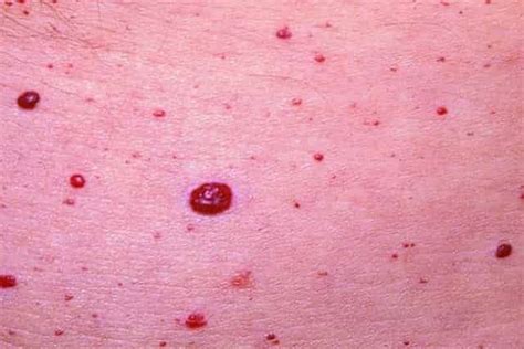 Red Spots On Skin Patches Small Tiny Pinpoint Not Itchy Pictures