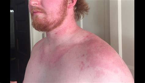 Clinical Challenge Rare Type Of Urticaria Mpr