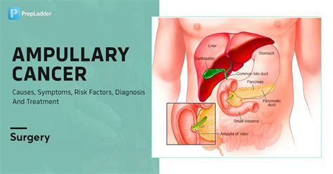 Ampullary Cancer Causes Symptoms Risk Factors Diagnosis And Treatment