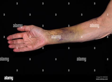 Patient With A Bruise Hematoma On The Right Arm After Insertion Of A