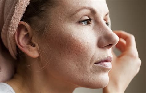 What Causes Broken Capillaries On The Face