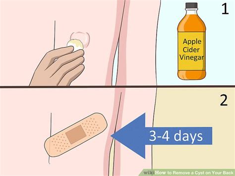 4 Ways To Remove A Cyst On Your Back Wikihow