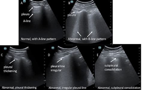 Lung Ultrasounds A Normal Lung Ultrasound A Lines Are Horizontal