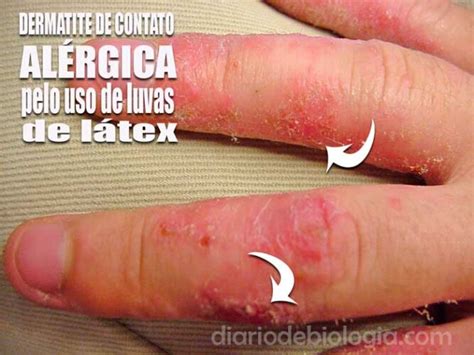 Dermatite De Contato Tudo Que Você Precisa Saber Sobre A Doença