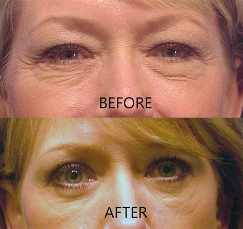 Lasik eye surgery is easy with vsp when you have the laser vision care program benefit. Upper Blepharoplasty - Blepharoplasty/Cosmetic/Eyelid Surgery/Graves/Dallas/Grant Gilliland