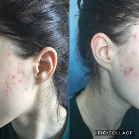 Acne Can Someone Help With This Ive Had It For 3 Months And I Feel