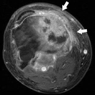 Here we have everything you need 69-year-old man with Merkel cell carcinoma. CT of the face ...