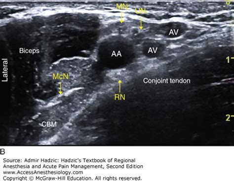Ultrasound Guided Axillary Brachial Plexus Block Hadzics Textbook Of