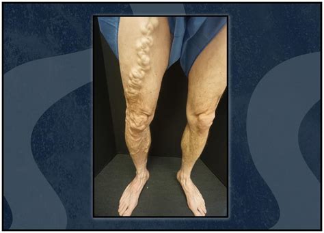Top 10 Reasons To Get Your Legs Checked Out You Might Have A Vein