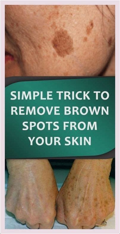 Brown Spots Dark Spots On Face Brown Spots Brown Spots On Face