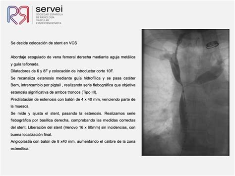 Síndrome De Vena Cava Superior Svcs Tratamiento Mediante Stent