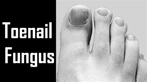 3 Ways To Treat A Toenail Fungus Using Natural Remedies