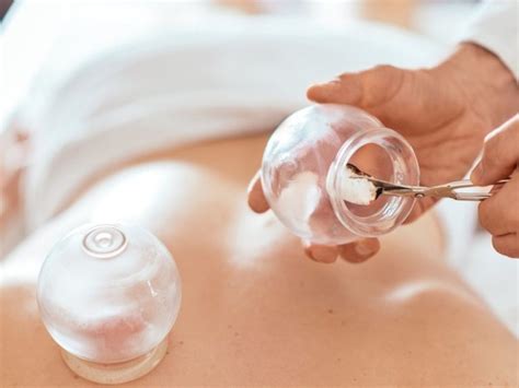 What You Should Be Aware Of Regarding Cupping Therapy