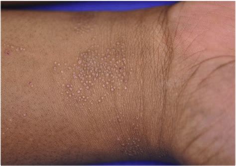 Lichen Planus And Other Lichenoid Dermatoses Kids Are Not Just Little