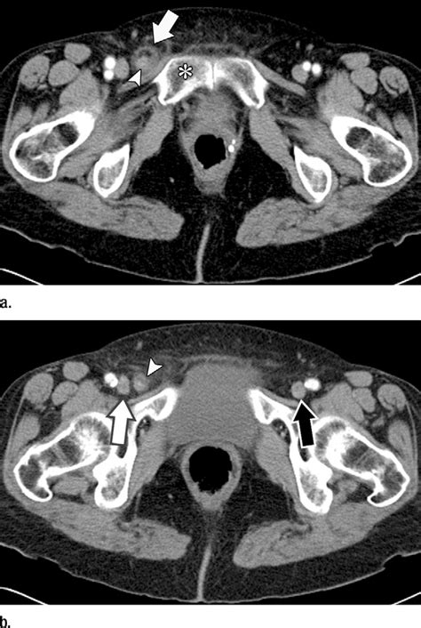 A Axial Intravenous Contrast Enhanced Ct Image Of The Pelvis Through