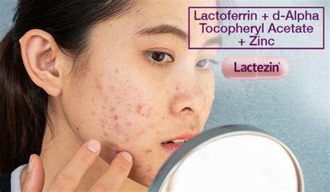 Adult Acne 5 Causes And Treatments Lactezin