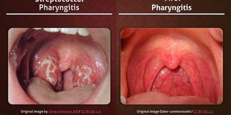 Pharyngitis Health Life Media