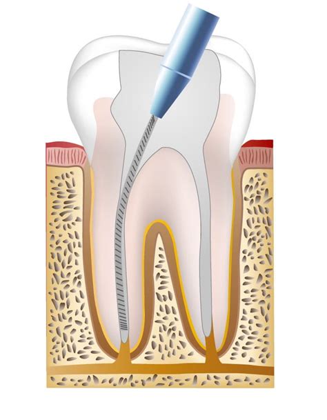 Endodontologie Zahnarzt Junghans