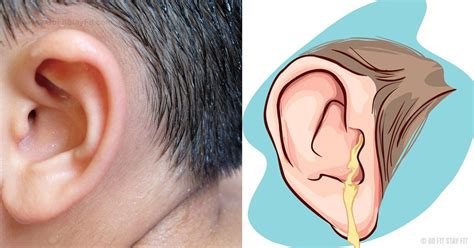 Natural Ways To Get Rid Of Clogged Ears Ear Wax Removal Ear Wax