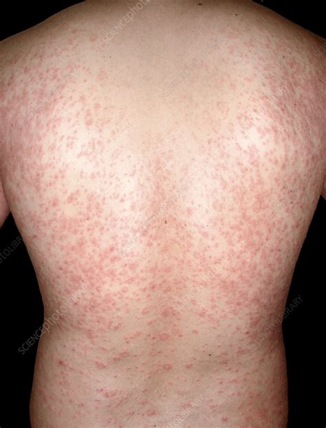 Pityriasis Rosea Skin Rash By Cnriscience Photo Library