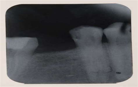 Sighting Radiograph Of The Second Premolar Of The Lower Jaw Before