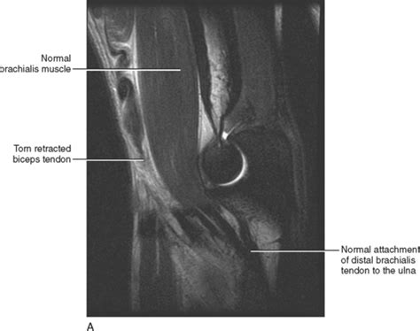 Imaging Of The Elbow Radiology Key