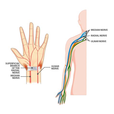 Ulnar Nerve Entrapment Causing Pinky Or Ring Finger Numbness