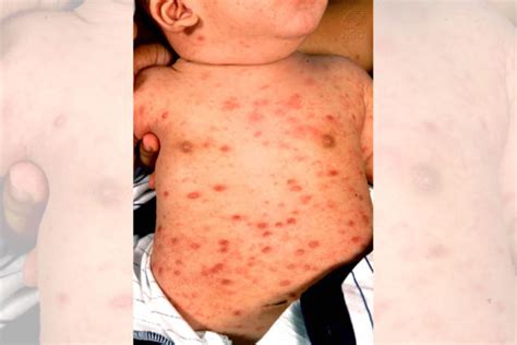 10 Common Skin Rashes In Children Hergamut