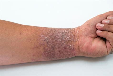 Eczema In Skin Of Color Aveeno