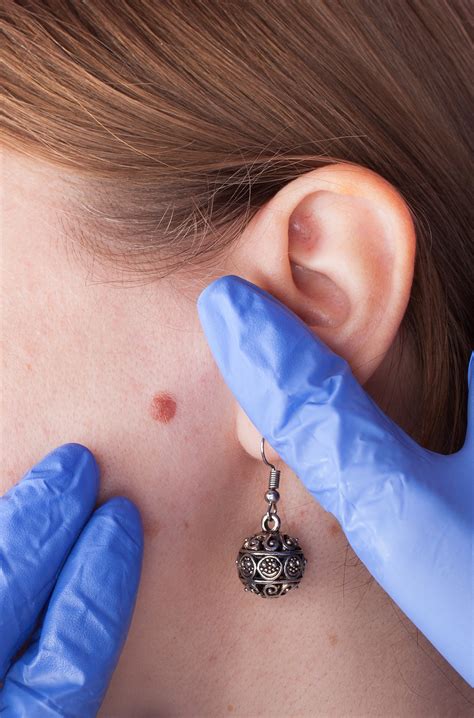 Warts And Molluscum Contagiosum Gem State Dermatology