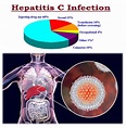 Hepatitis C : Sign & Symptoms, Transmission, Risk factors, Diagnosis ...