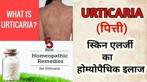 Urticaria Hives 5 Best Homeopathic Medicines For Urticaria Skin