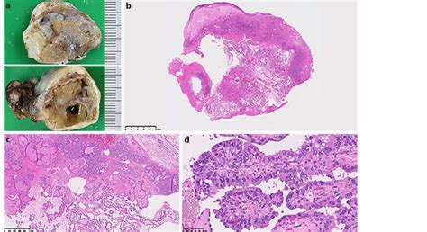 Macroscopic And Microscopic Views Of The Papillary Thyroid Carcinoma In