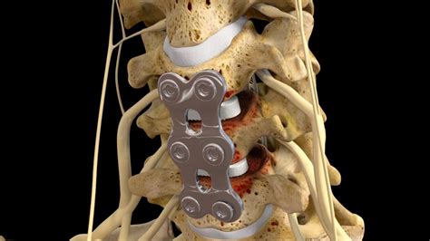 C5 6 C6 7 Anterior Cervical Discectomy With Fusion