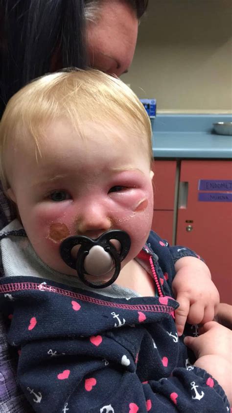 Mom Warns About Sunscreen After Toddler Ends Up In Er With Bad Reaction