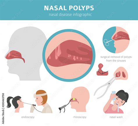 Nasal Diseases Nasal Polyps Causes Diagnosis And Treatment Medical Infographic Design Stock