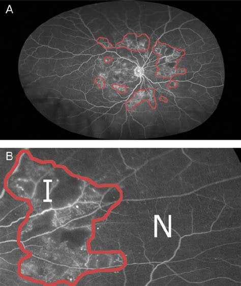 A A Sample Ultra Widefield Fluorescein Angiogram Retinal Ischaemia