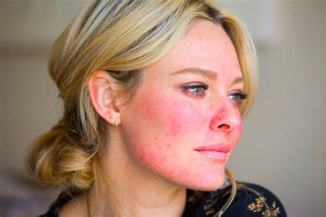 How To Cope With Rosacea Good Living From Pure Beauty Online