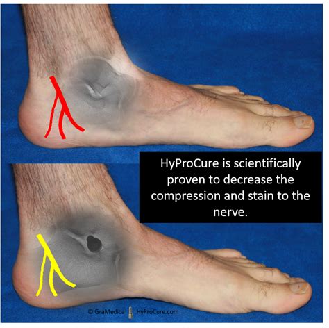 Plantar Neuropathy Hyprocure The Proven Solution To Misaligned Feet