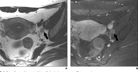 Figure 1—37 From Mri For Pretreatment Lymph Node Staging In Uterine