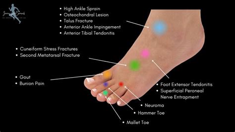 Update 132 Heel And Lateral Foot Pain Best Esthdonghoadian